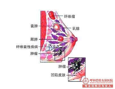 乳腺腫瘤不治療有什么危害